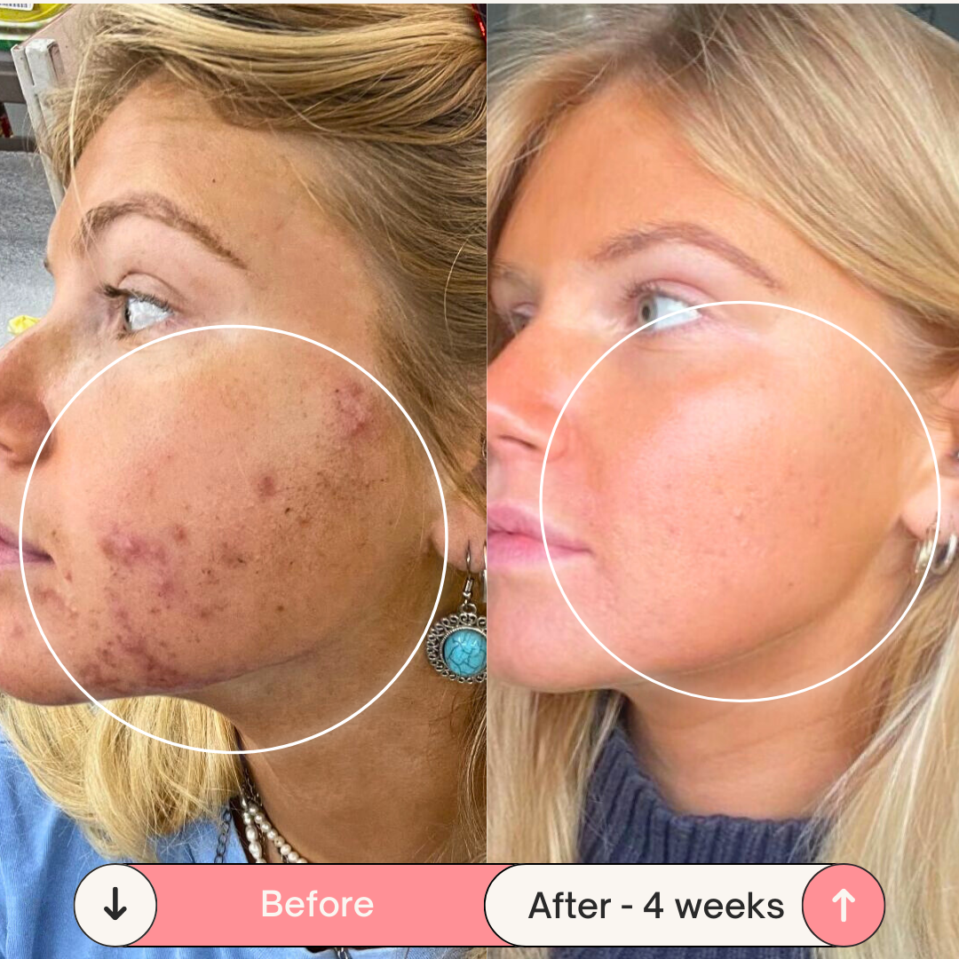 Clear Skin Magic Wand ™