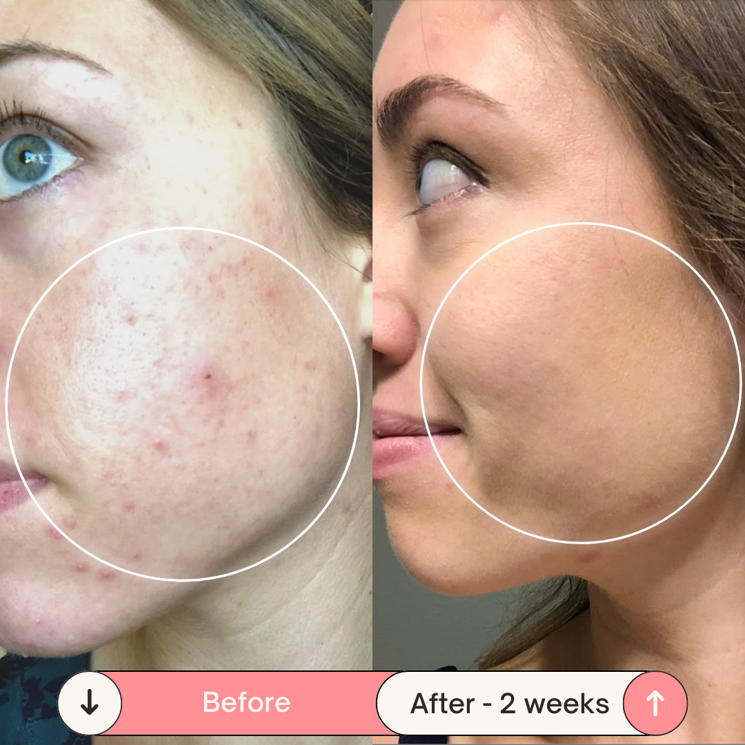 Clear Skin Magic Wand ™