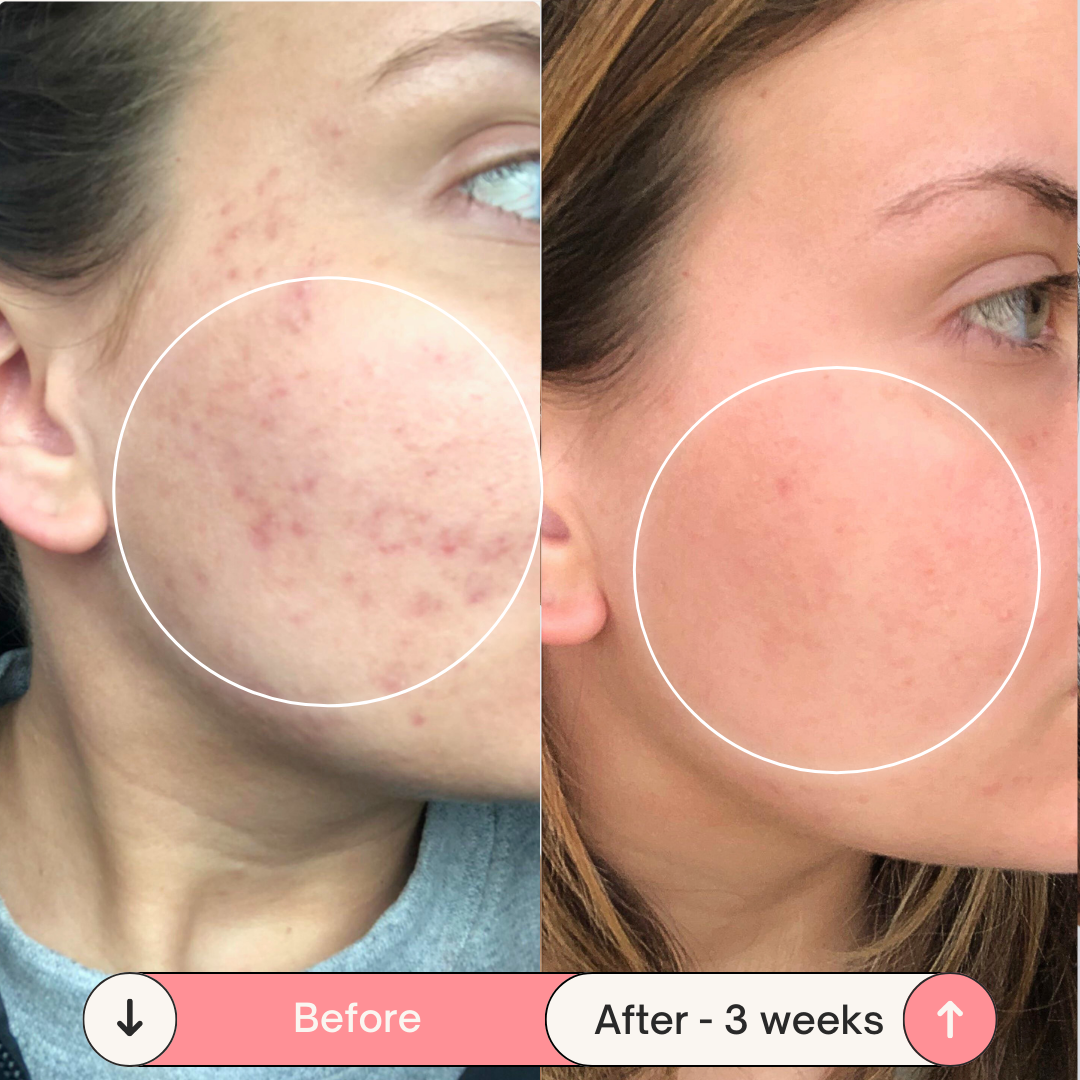 Clear Skin Magic Wand ™