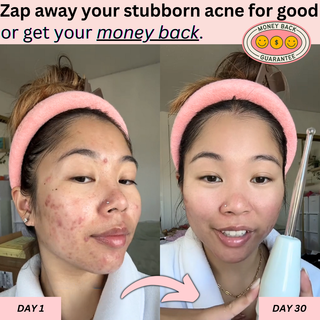 Clear Skin Magic Wand ™
