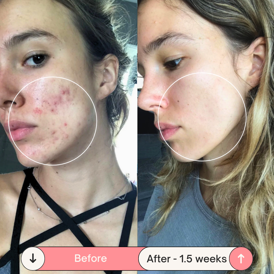 Clear Skin Magic Wand ™