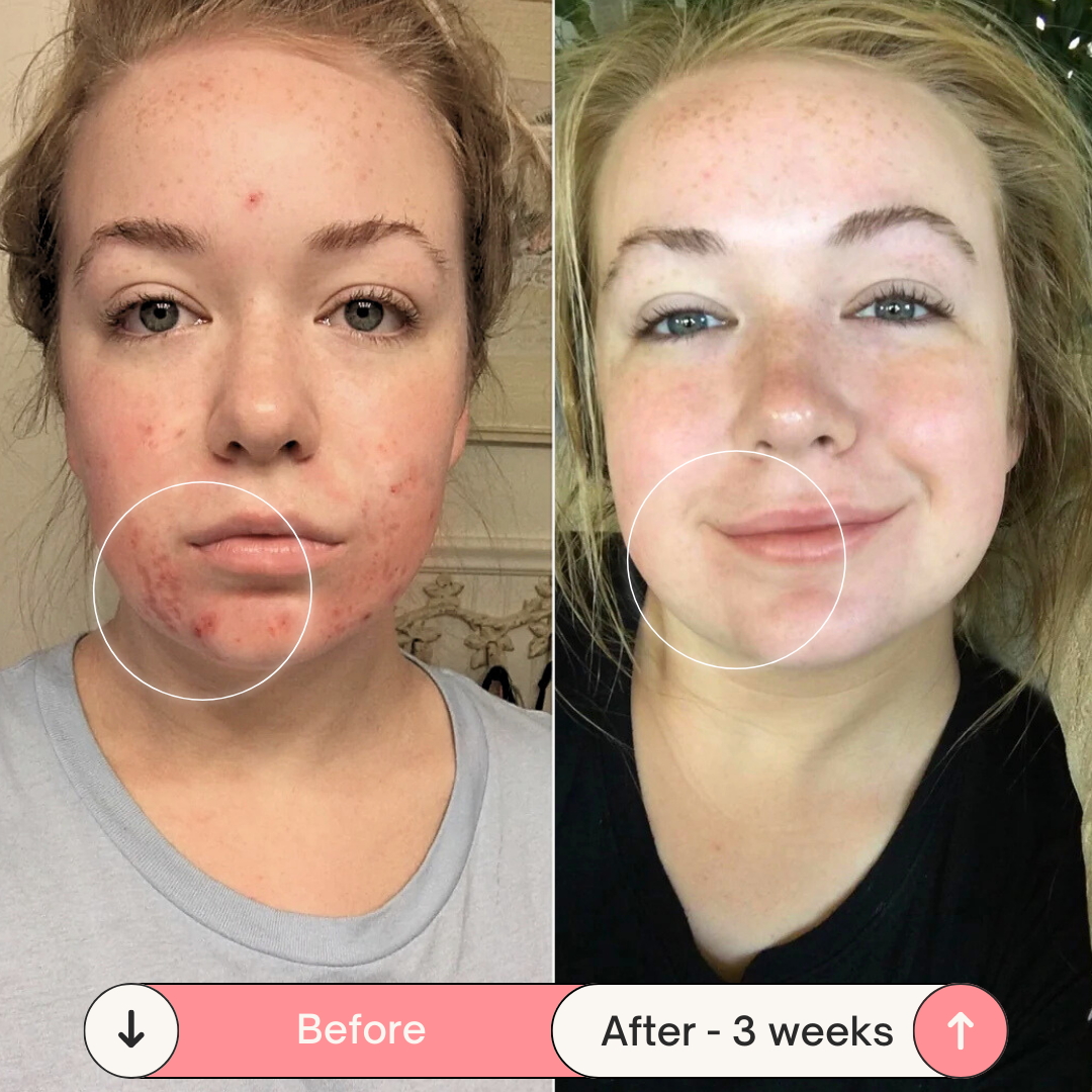 Clear Skin Magic Wand ™